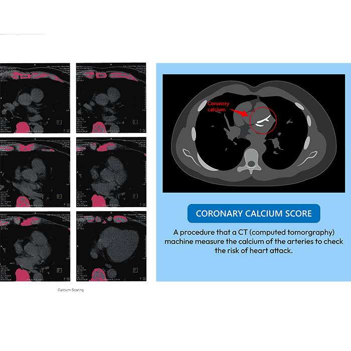 Coronary Artery Calcium (CAC) scan