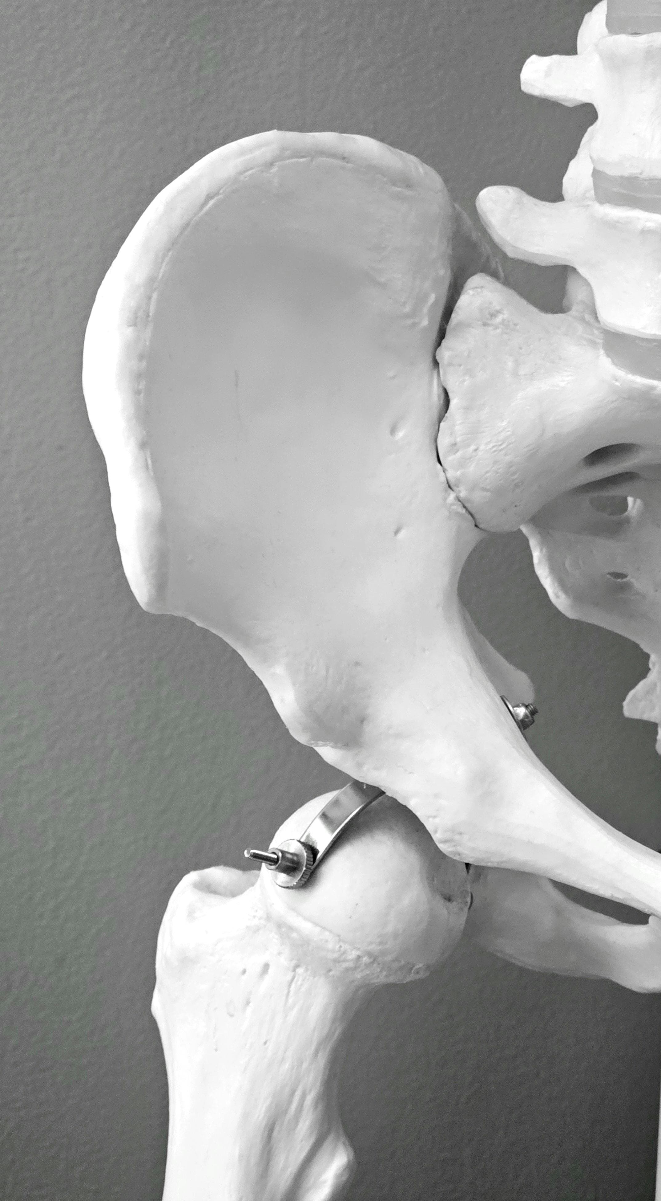 Hip Surgery
