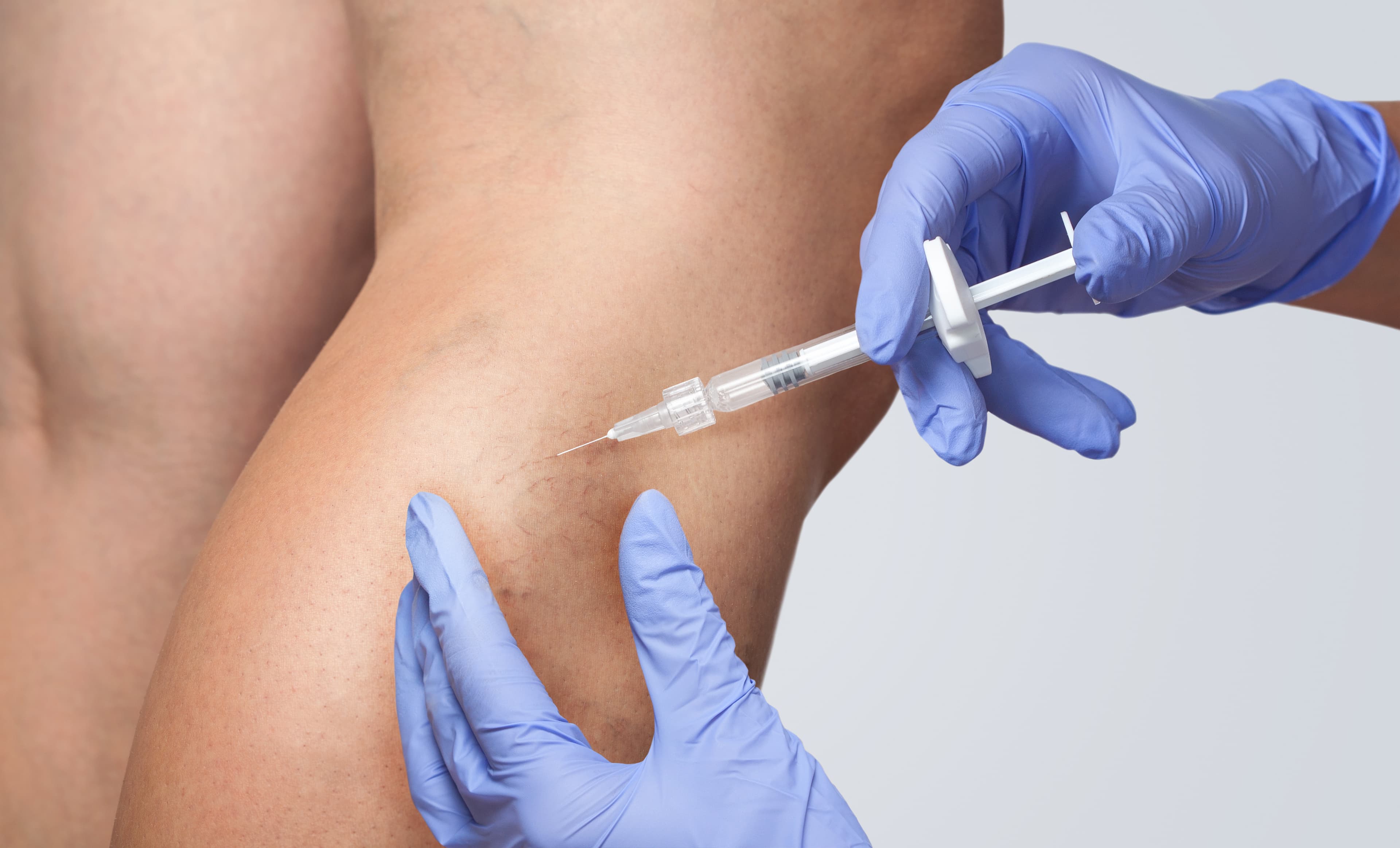 Varicose Veins Treatment